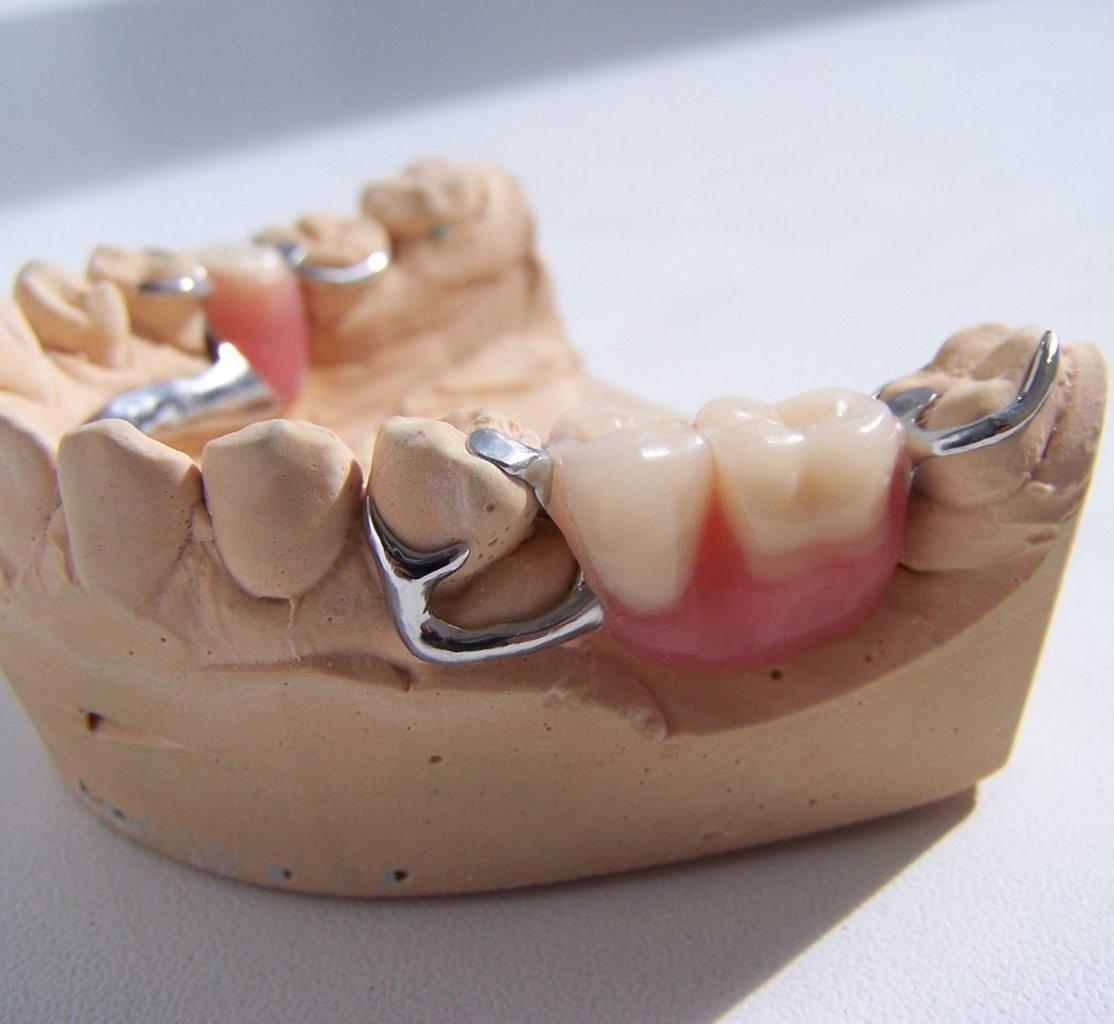 Бюгельный зубной протез