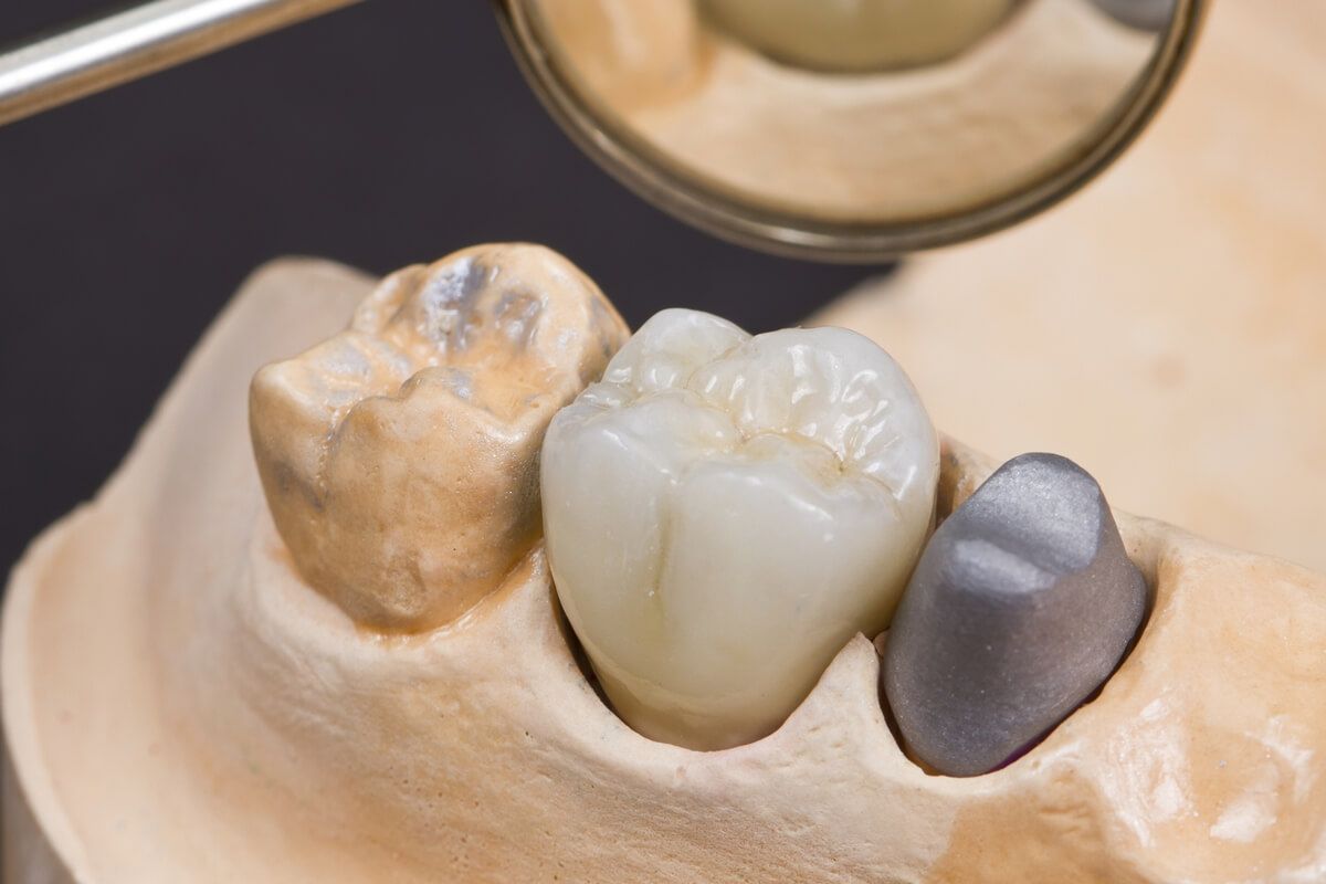 Протезирование зубов в казани. Металлокерамическая коронка а1 120. Металлокерамической коронки (никель/хром). Металлокерамические коронки (на винтовой и цементной фиксации). Колодка с металлокерамической.